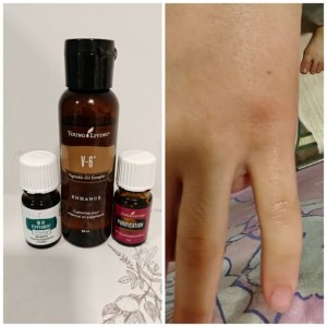 蚊叮蟲咬用什麼?